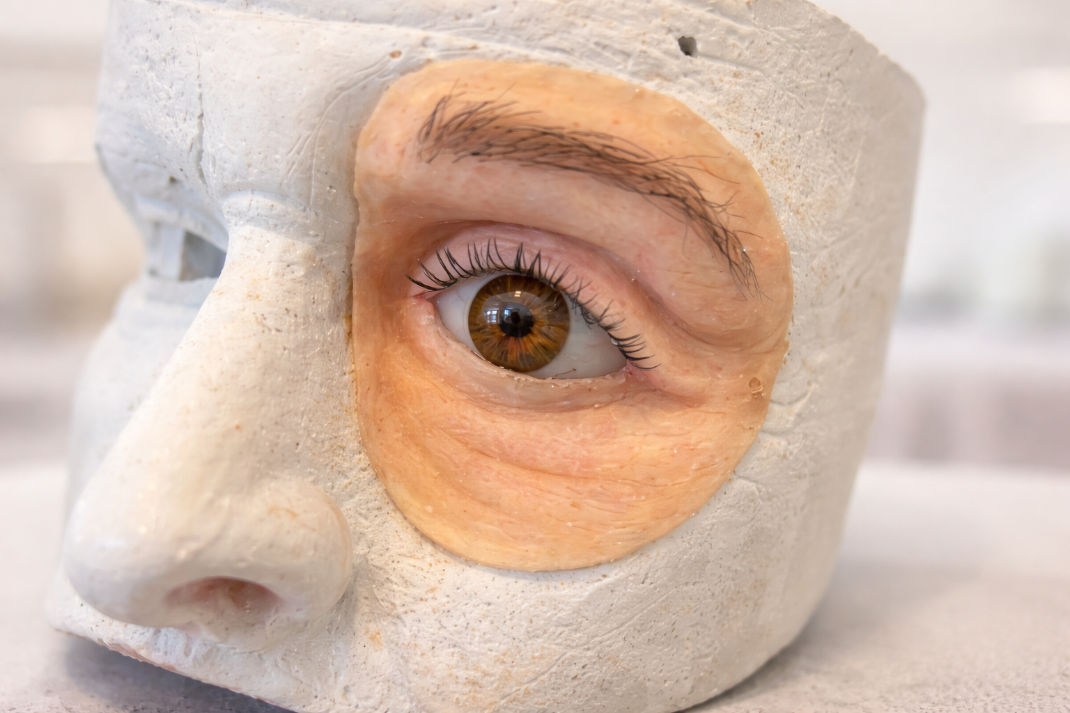 Prótese ocular bucomaxilofacial em processo de confecção na Gemola em Joinville SC